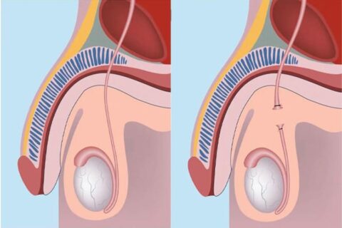 Vasectomie Paris Groupe Urologie Paris Ouest vasectomie-paris-groupe-urologie-paris-ouest
