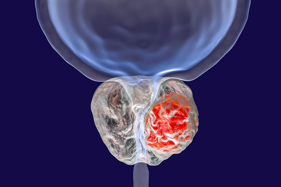 convalescence adenome prostate dr gambachidze chirurgien urologue paris groupe urologie paris ouest
