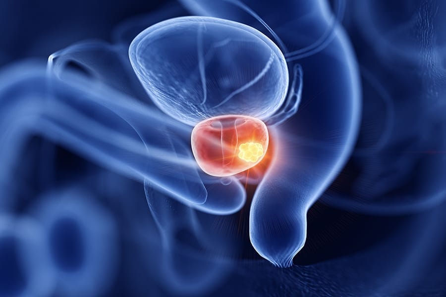 embolisation prostate dr gambachidze centre urologie paris ouest